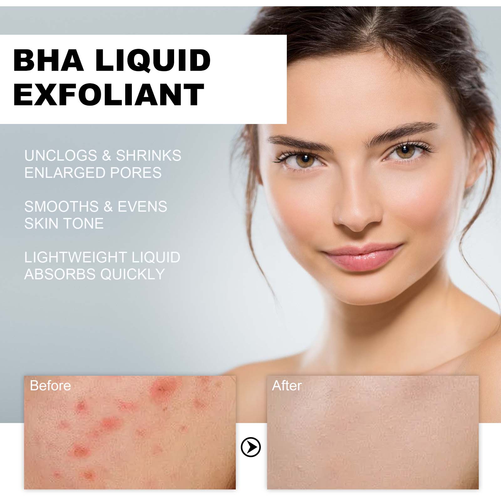 2% 살리실산 액상 각질 제거제 모공 축소 세럼, 확대 - Tranexamic Acid Serum 리뷰 및 가격