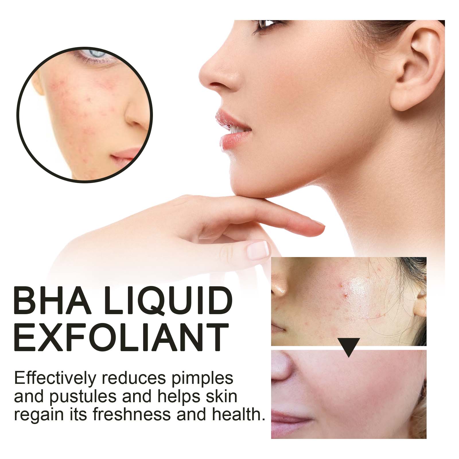2% 살리실산 액상 각질 제거제 모공 축소 세럼, 확대 - Tranexamic Acid Serum 리뷰 및 가격